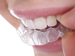 Estetik Ortodontik Tedavi (invisalign) | Kavacık Beykoz Diş Kliniği