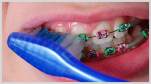 dentorama-cocuklarda-ortodontik-tedavi
